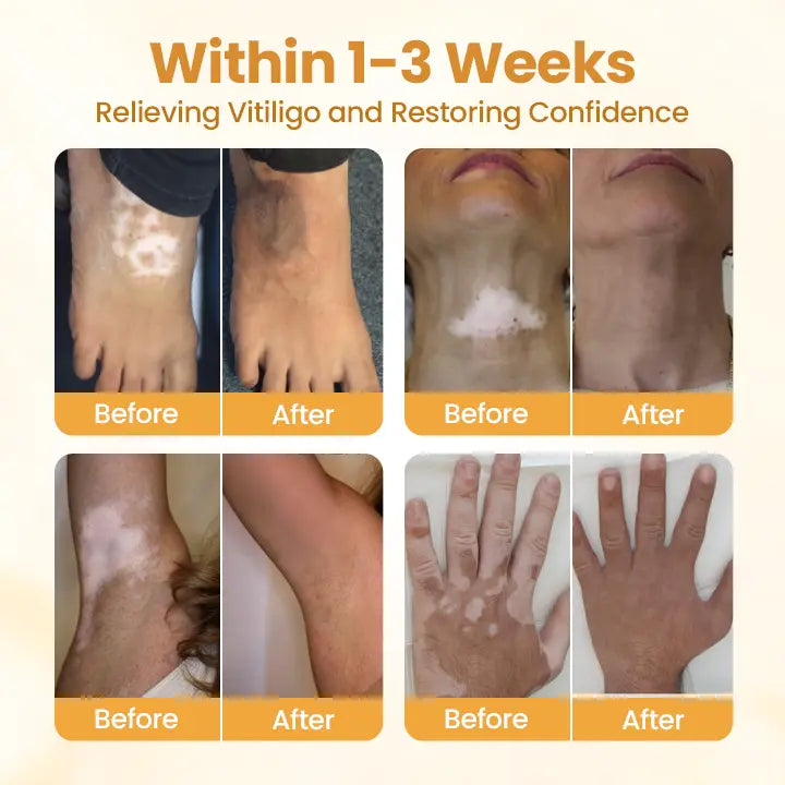VitiGO Bee Venom Cream | White Spots & Vitiligo Skin Care Cream