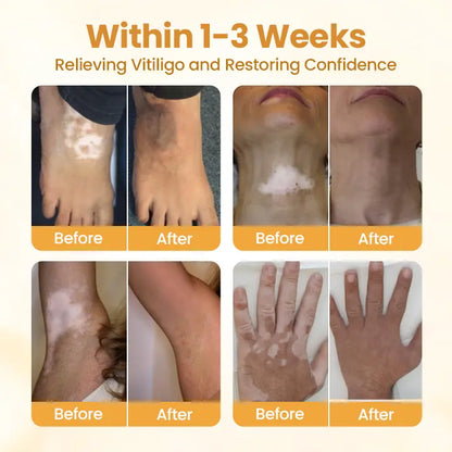 VitiGO Bee Venom Cream | White Spots & Vitiligo Skin Care Cream