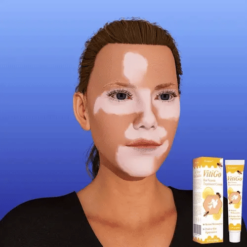 VitiGO Bee Venom Cream | White Spots & Vitiligo Skin Care Cream