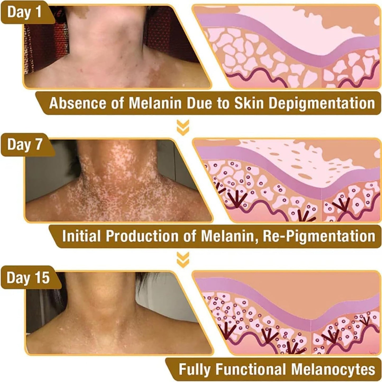 VitiGO Bee Venom Cream | White Spots & Vitiligo Skin Care Cream